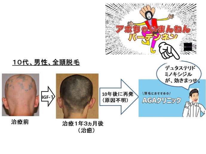 円形脱毛症　病院